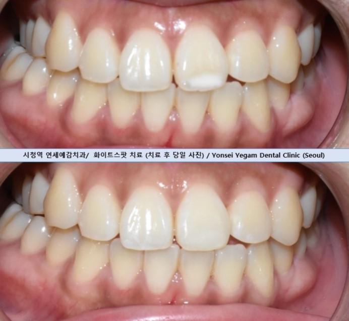 반점치, 반상치, 치아에 하얀 점 치료방법 전후사진, 가격 비용까지 관련 이미지 8