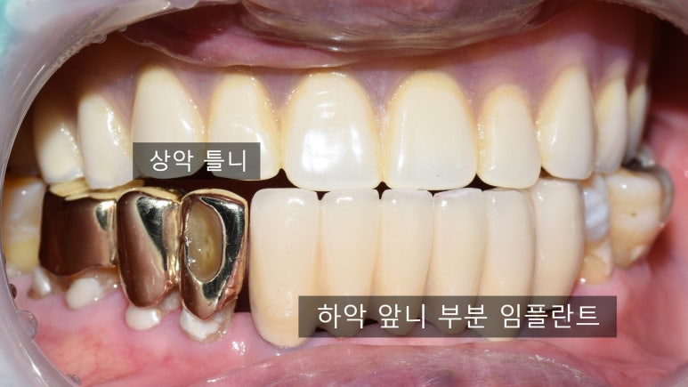 사용중인 틀니가 불편하다면? 임플란트와 틀니가 결합된 임플란트 틀니 추천 관련 이미지 13