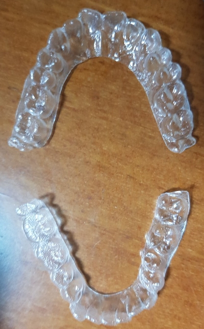 서울역 치과 투명교정 실제사례,비용가격 알아볼까요? 관련 이미지 1