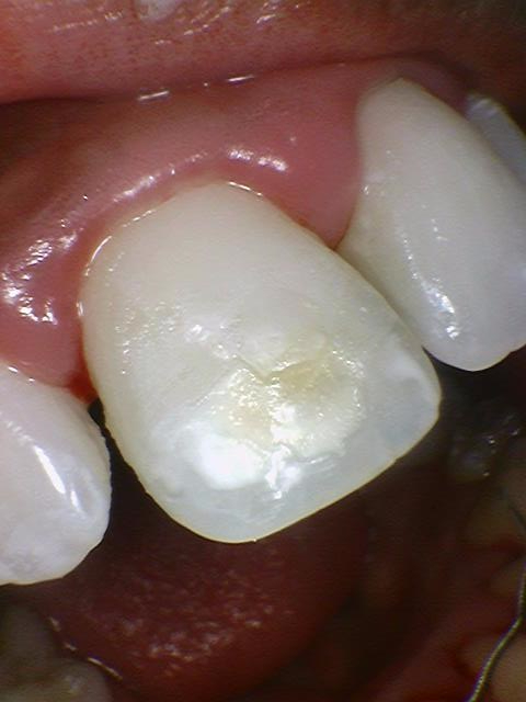 [서울역/충정로/치과] 화이트스팟+충치가 결합된 치아의 resin레진치료 케이스 관련 이미지 1