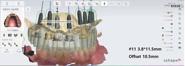 사용중인 틀니가 불편하다면? 임플란트와 틀니가 결합된 임플란트 틀니 추천 관련 이미지 4