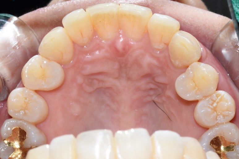 오래전 교정한 치아가 틀어져서 부분 재교정 케이스, 비용가격[광화문/서울역/치과] 관련 이미지 3