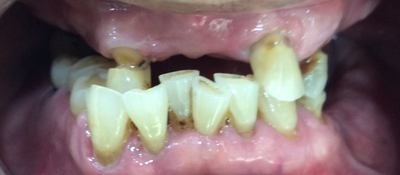 남대문시장가까운치과, 명동,서울역&용산가까운치과, 틀니치료 사례 관련 이미지 13