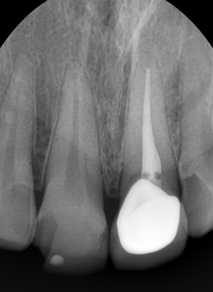 [시청역/광화문]라미네이트케이스:"치아가 작아서 옹졸해 보여요. 치아가 길어보이면 좋겠어요" 관련 이미지 3