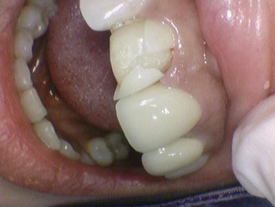 앞니 치아가 부러졌다면? 앞니부러짐 시청역 서울역 치과 치료사례 관련 이미지 9
