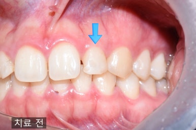 [서울/시청역] 양쪽 두 개 왜소치 오래된 레진 떨어져서 라미네이트 한 케이스(+라미네이트 가격) 관련 이미지 5