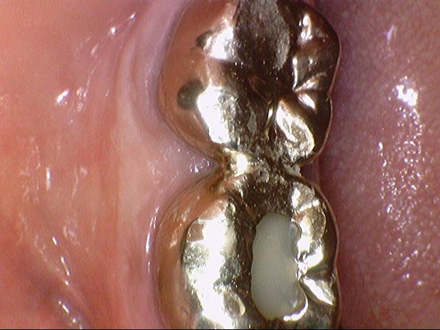 해외에서도 믿고 찾아오는 서울 시청역 치과 연세예감치과에서 소개하는 지르코니아 크라운 관련 이미지 13