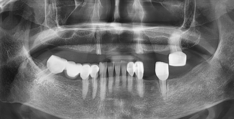 앞니 여러개 임플란트 잘하는 치과 서울역치과 실제사진 관련 이미지 21