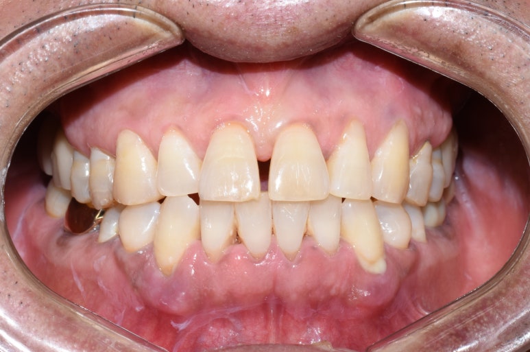 [서울시청역/남대문]어금니임플란트+상악동거상술(뼈이식):실제케이스 관련 이미지 10