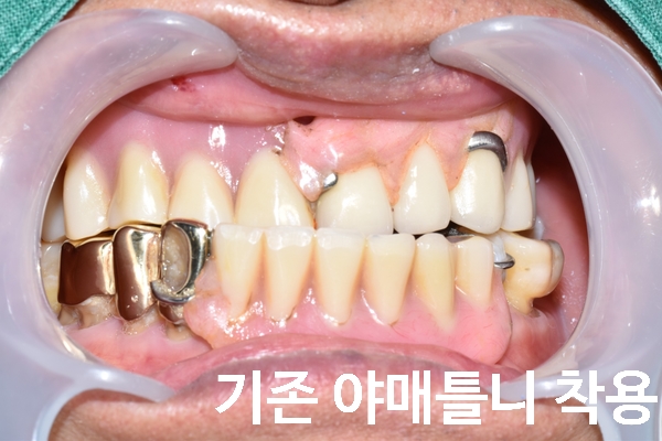 [남대문] 치과임플란트 조금더 덜아프고, 간단하게! 관련 이미지 3