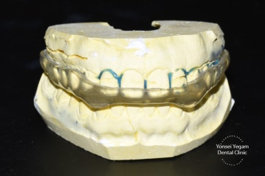 Teeth grinding, Bruxism: Botox, Night Guard in Seoul /  price 관련 이미지 3