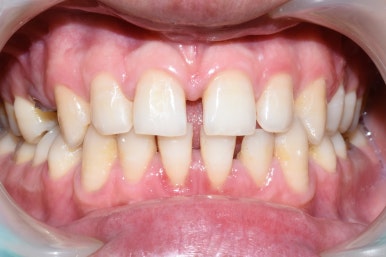 스케일링 처음 받는 분들도 많이 찾아오는 광화문 시청역 삼성본관 바로 앞 치과 관련 이미지 4