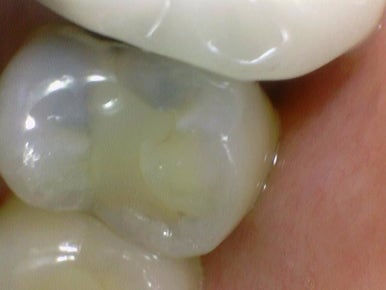 시청역치과 객관적인 근거로 치료하며, 환자분께 치료 전 치료해야하는 이유를 보여드립니다. 관련 이미지 2