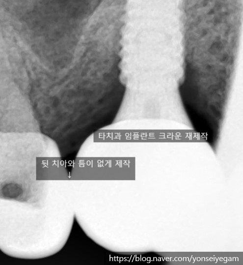 시청역치과 [Q&A]다른치과에서 한 인레이,크라운,임플란트에 음식물이 껴요 관련 이미지 3