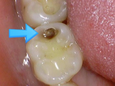 [서울시청역] 눈에 보이지 않는 충치 실제사진 관련 이미지 7