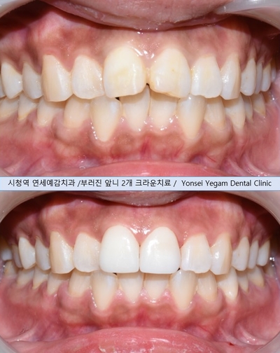 [시청역 치과]앞니가 튀어나왔어요&부러졌어요 ->앞니를 바르고 예쁘게,앞니 크라운 관련 이미지 5