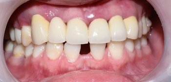 시청역치과 벌어진 앞니를 바르고 이쁘게! 대한심미학회회원치과 관련 이미지 9