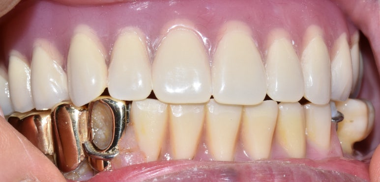 사용중인 틀니가 불편하다면? 임플란트와 틀니가 결합된 임플란트 틀니 추천 관련 이미지 12