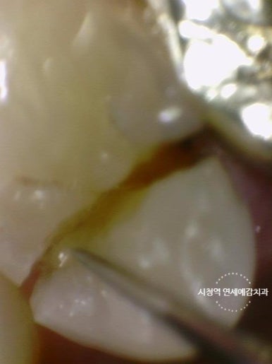 광화문 시청치과 치아가 쪼개졌어요 실제사례 관련 이미지 2