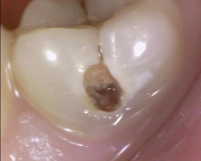 시청역치과 심한 (앞니)충치 치료방법 전후 사례 살펴보아요 관련 이미지 5