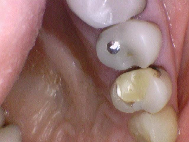 치아를 하얗게 하고 싶은 캐나다에서 오신 환자분의 라미네이트 사진공개이벤트진행중 관련 이미지 4