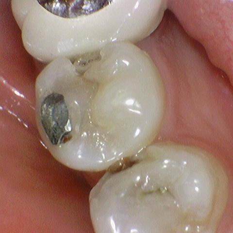 [서대문/광화문]외국인도 찾아오는 치아색나는 크라운, 지르코니아 크라운 치료 치과 어떻게 변하는지 확인해보아요 관련 이미지 3