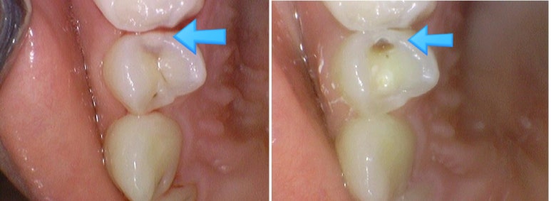 [을지로/치과] 하얀색 이맥스 인레이 세라믹인레이 / 실제 케이스/ 비용 가격 알려드려요 관련 이미지 4