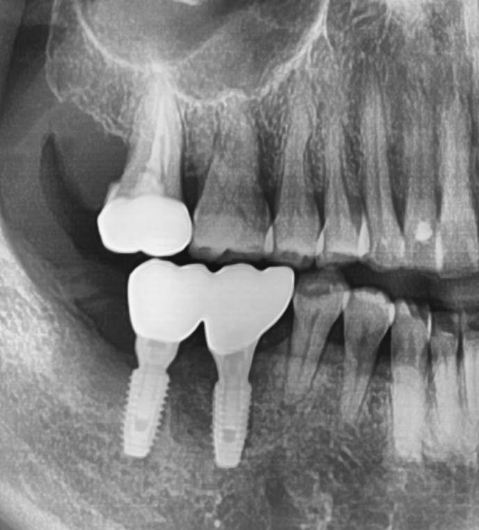 오래된 임플란트가 흔들려요 인플란트 재수술도 서울역가까운치과 연세예감치과 관련 이미지 17
