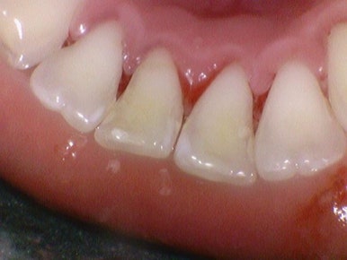 스케일링 처음 받는 분들도 많이 찾아오는 광화문 시청역 삼성본관 바로 앞 치과 관련 이미지 7