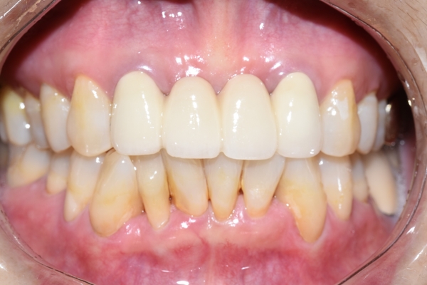 [치과브릿지]남대문치과/깨지고 오래된 앞니브릿지 교체케이스 관련 이미지 5