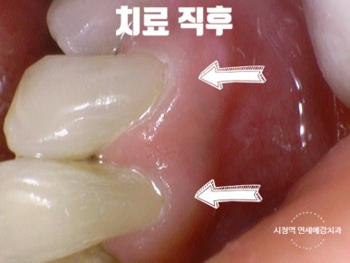 남대문치과 치아가 시리다면? 잇몸패임인가요? 관련 이미지 5
