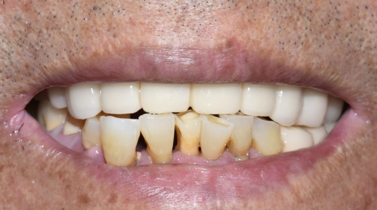 사용중인 틀니가 불편하다면? 임플란트와 틀니가 결합된 임플란트 틀니 추천 관련 이미지 17