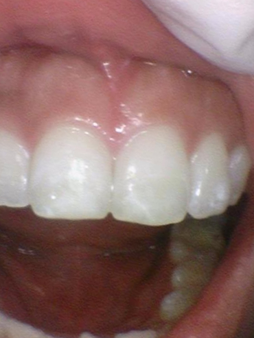 [서울 광화문/남대문] 화이트스팟 레진으로 치료케이스, 비용안내 등등 / 반점치, 반상치 관련 이미지 9