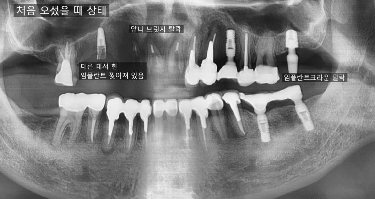 앞니 여러개 임플란트 잘하는 치과 서울역치과 실제사진 관련 이미지 7