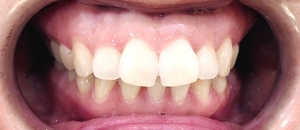 시청역치과 연세예감치과의 2번만의 내원으로 완성되는 고른앞니 만들기 케이스 소개 관련 이미지 2