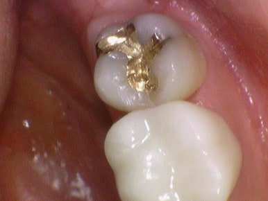 [서울/시청역]어금니 치아가 깨져서 크라운이 필요하다면? 관련 이미지 2