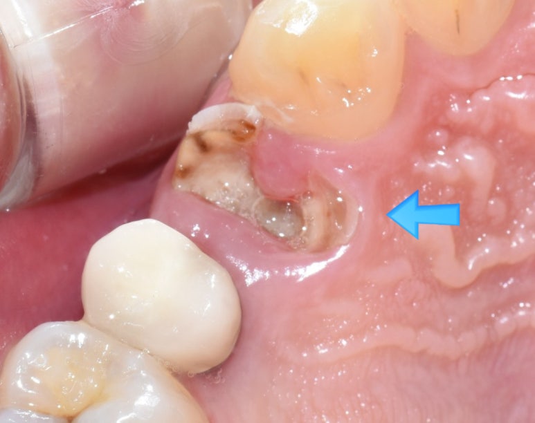 시청역 충정로 충치치료 치과 추천 관련 이미지 15