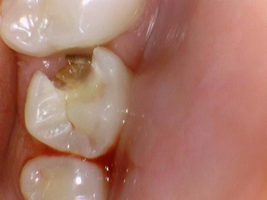 [시청역치과] 미국에서도 크라운 하러 일부러 찾아오는 치과 인증사진 관련 이미지 3