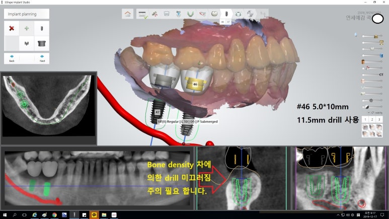 시청역 광화문  최소절개 또는 비절개로 가능한 네비게이션 임플란트 유명한 치과 내비게이션소개드려요 관련 이미지 16