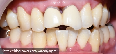 [서울시청역치과/잇몸치료]Q.잇몸에서 피가 나요 관련 이미지 2