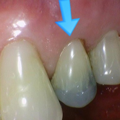 시청역 크라운 붙이기까지. 구강스캔으로 너무 길지도 짧지도 않게 3일째 가능합니다. 가격안내 관련 이미지 3