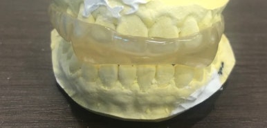 이갈이가 있다면? 이갈이 장치, 그냥 인터넷으로 사서 해도 되나요?/치과 이갈이장치 비용안내 관련 이미지 3