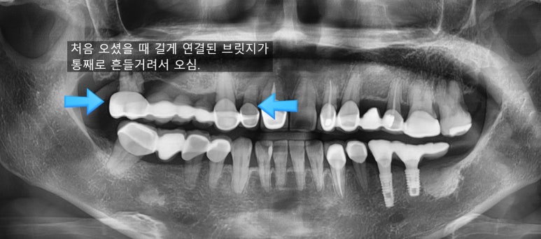 앞니 여러개 임플란트 잘하는 치과 서울역치과 실제사진 관련 이미지 1