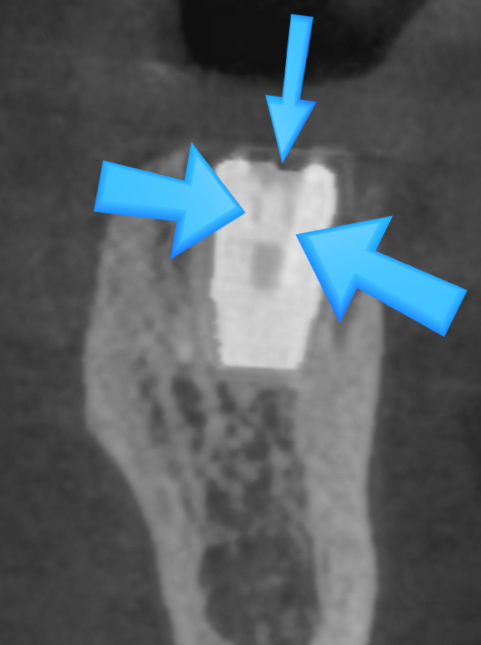[서울시청역/케이스]"다른 치과에서 한 임플란트가 흔들려서 빼야할 것 같아요" 관련 이미지 11