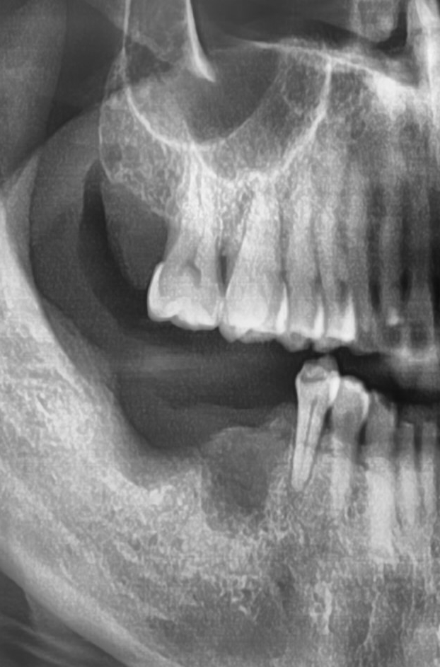 [서울시청역/케이스]"다른 치과에서 한 임플란트가 흔들려서 빼야할 것 같아요" 관련 이미지 10