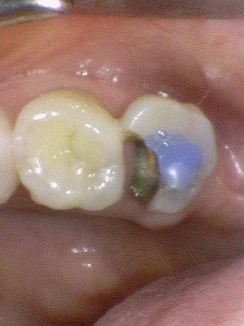 광화문 연세 예감 치과 해외에서도 찾아오는 지르코니아크라운 치료 안내해드려요 관련 이미지 11