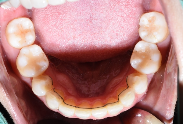 Q&A:"교정을 예전에 오래전에 했는데 앞니치아가 삐뚤어졌어요"해결방법은, 비용은? 관련 이미지 4
