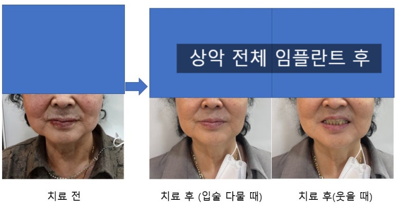 서울 중구 치과/이가 하나도 없는 환자의 치료방법/틀니, 풀아치임플란트, 전체 임플란트 등 관련 이미지 11
