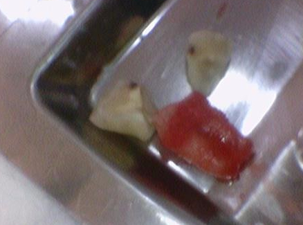 광화문 시청치과 치아가 쪼개졌어요 실제사례 관련 이미지 4