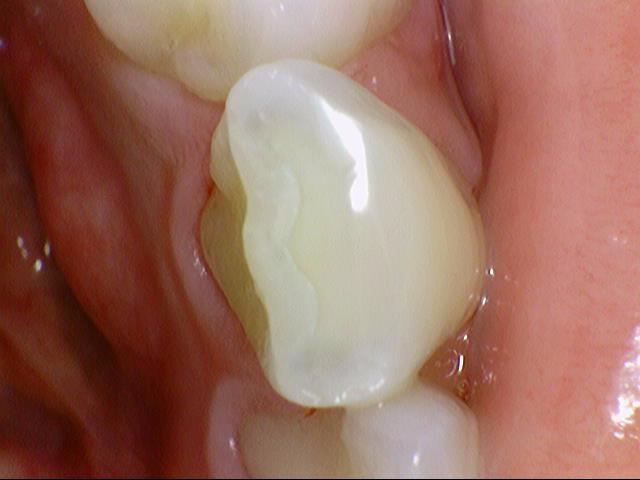 이갈이원인 증가요인 이갈이 치료방법 비용 관련 이미지 2